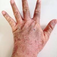 Nepríjemná atopická dermatitída